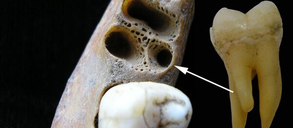 Molar inferior de tres raíces  - Sputnik Mundo