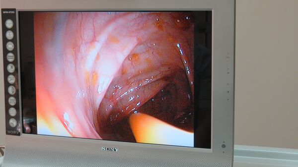 Trasplante fecal: ¿un tratamiento revolucionario o una locura moderna? - Sputnik Mundo