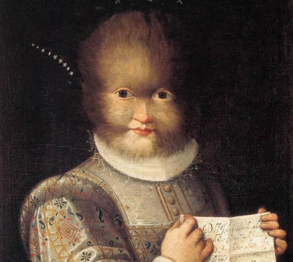 Error farmacéutico causa 'síndrome de hombre lobo' en niños españoles - Sputnik Mundo