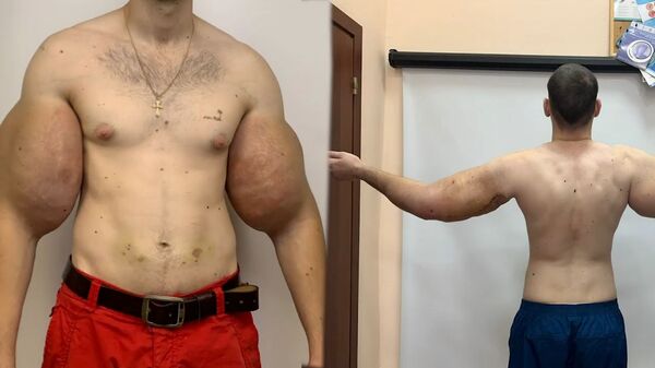 La nueva vida del 'Popeye ruso': Kiril Terioshin se somete a una cirugía de bíceps | Vídeo - Sputnik Mundo