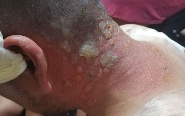 Joven con quemaduras por agua lanzada desde camión hidrante de carabineros, el jueves 5 de diciembre de 2019 - Sputnik Mundo