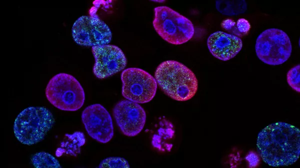 Células de cáncer durante tratamiento (archivo) - Sputnik Mundo