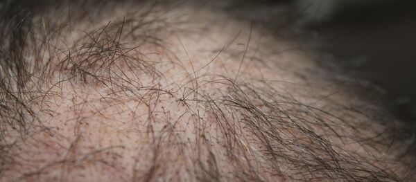 Calvo. Calvicie. Alopecia. Imagen referencial - Sputnik Mundo