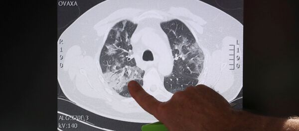 Un examen muestra unos pulmones de un paciente infectado por el COVID-19 - Sputnik Mundo