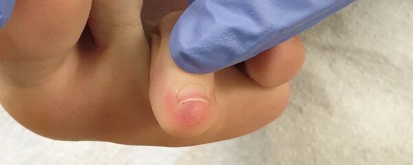 Mancha púrpura en el pie, síntoma de coronavirus - Sputnik Mundo