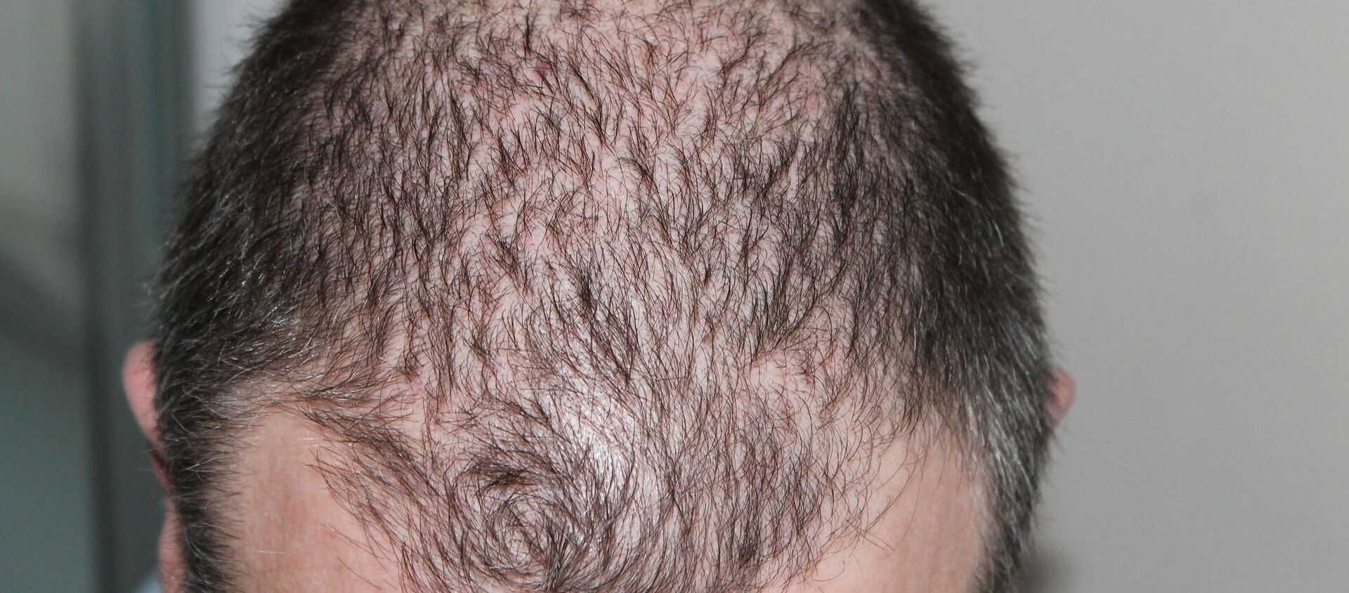 Hombre con alopecia - Sputnik Mundo, 1920, 19.05.2020