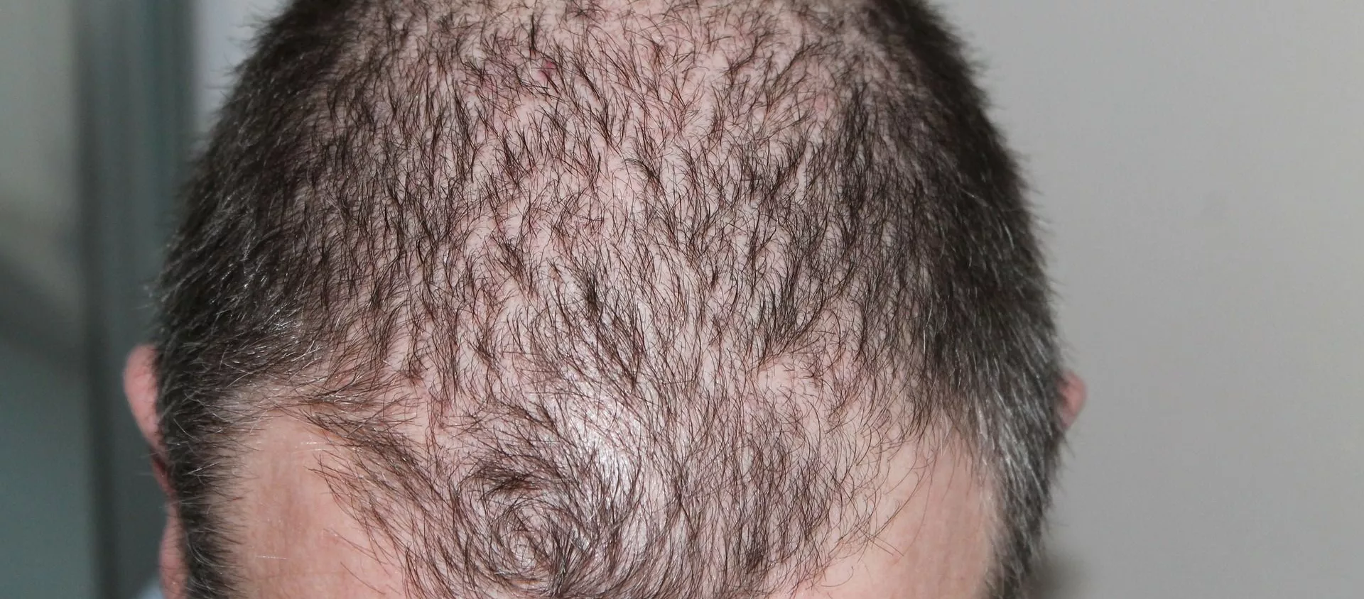 Hombre con alopecia Hombre con alopecia - Sputnik Mundo, 1920, 19.05.2020
